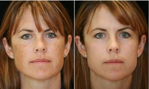 IPL Photofacial