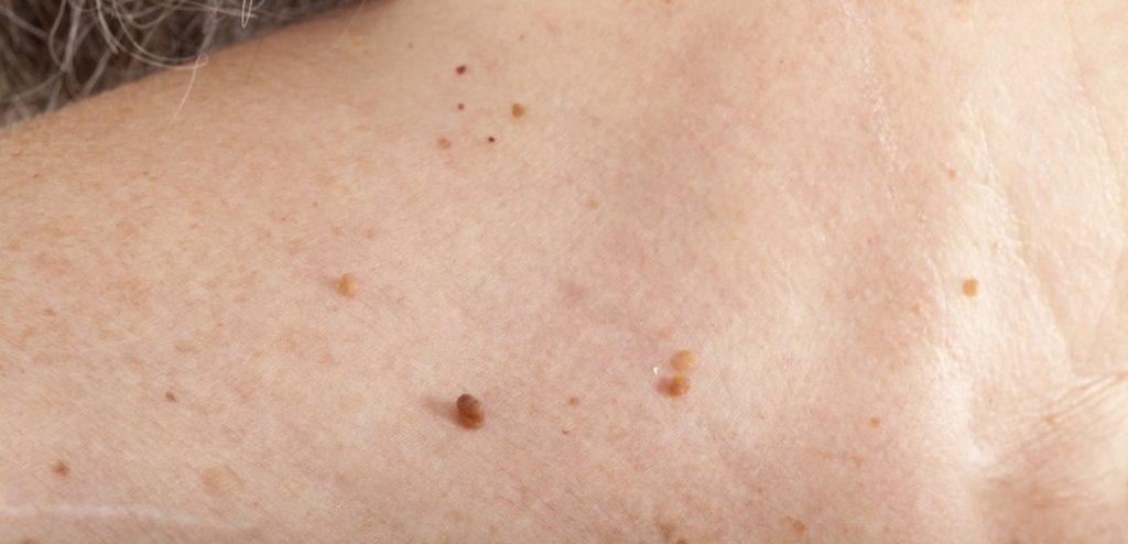 Skin Tag Removal